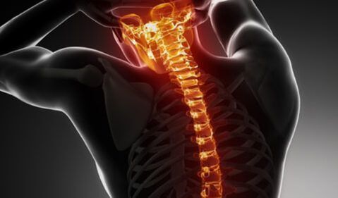 Osteochondrose van de hele wervelkolom
