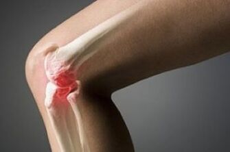 Arthrose van het kniegewricht is een laesie van kraakbeenweefsel