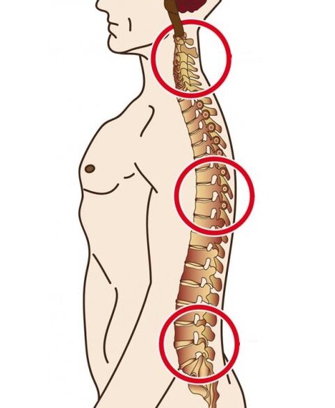 Spinale afdelingen waarin osteochondrose optreedt