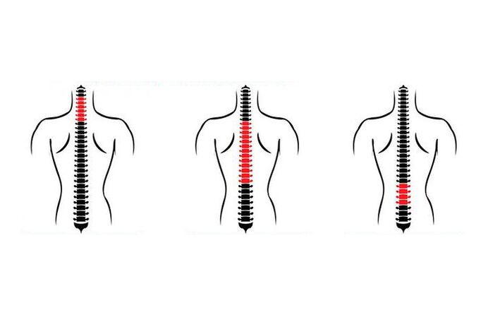 Hoe manifesteert osteochondrose zich