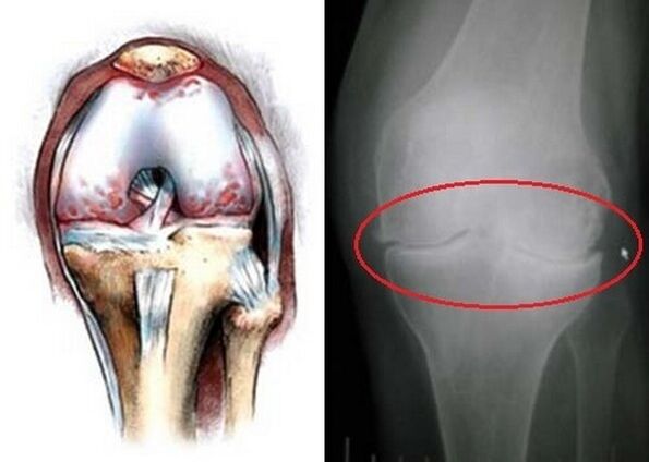 artrose van het kniegewricht