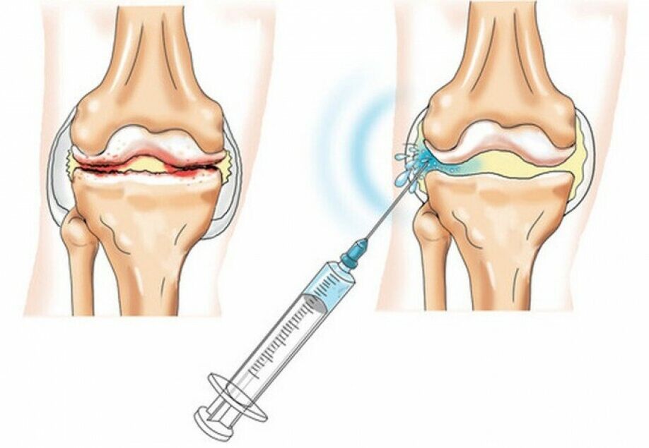 injectie in het kniegewricht bij artrose