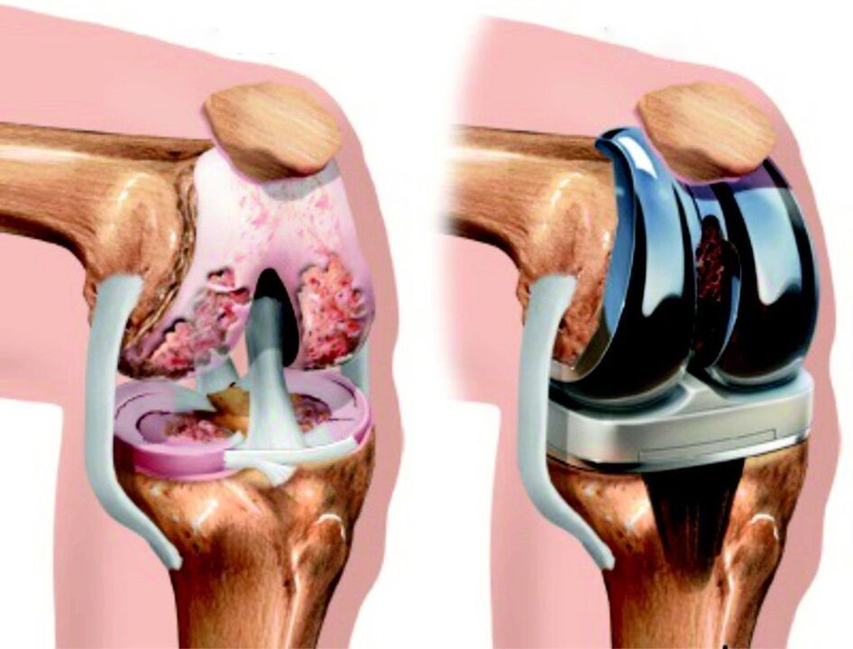 Bij totale schade aan het kniegewricht door artrose kan dit hersteld worden met endoprothesen