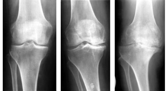 Een verplichte diagnostische maatregel bij het identificeren van artrose van de knie is een röntgenfoto