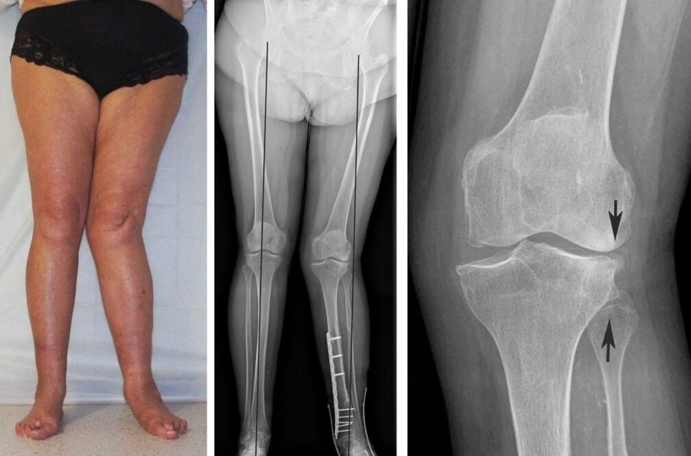 Geavanceerde artrose van de kniegewrichten is visueel duidelijk zichtbaar, zelfs zonder röntgenfoto's